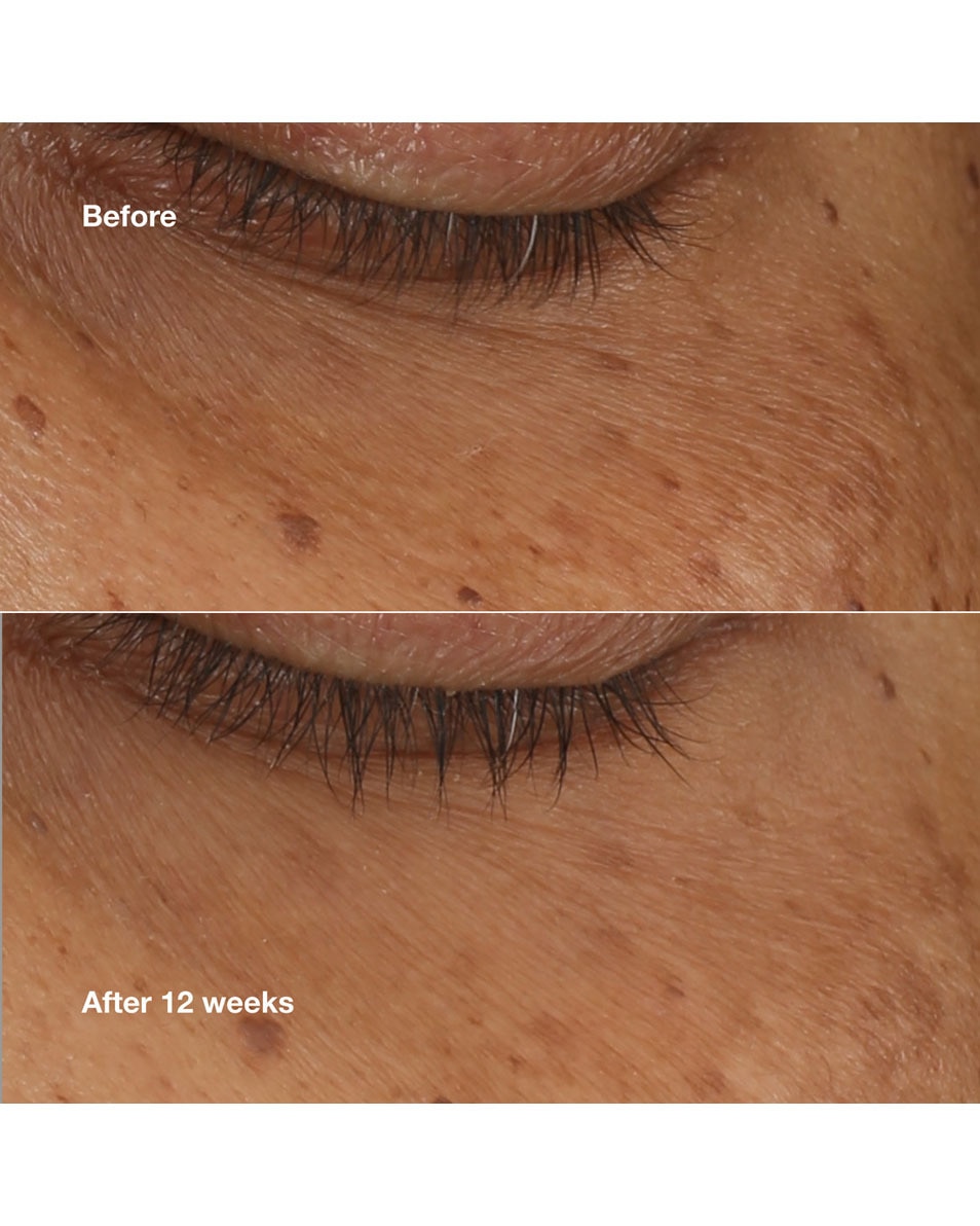 Lutter contre les cernes et les poches sous les yeux.